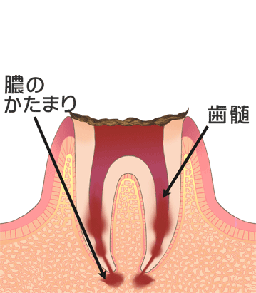 末期のむし歯